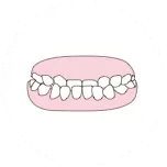 Crossbite