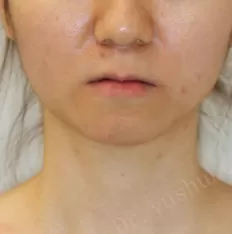 治療前の顔の写真