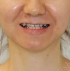 治療前の顔の写真