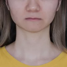 治療前の顔の写真