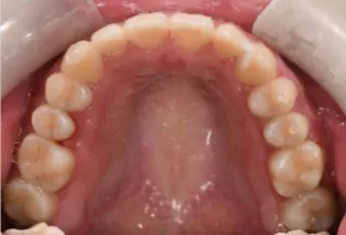 治療後の口腔内写真