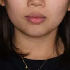 治療前の顔の写真