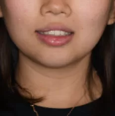 治療前の顔の写真