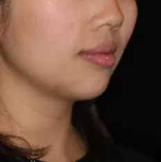 治療前の顔の写真