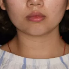 治療前の顔の写真