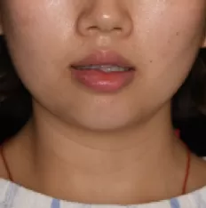 治療前の顔の写真