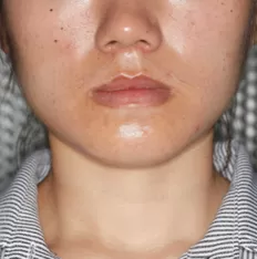 治療前の顔の写真