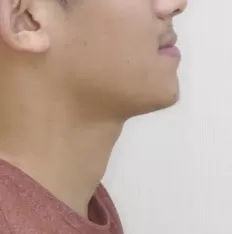 治療前の顔の写真