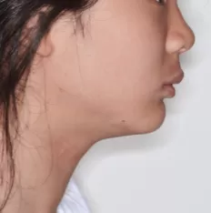 治療前の顔の写真