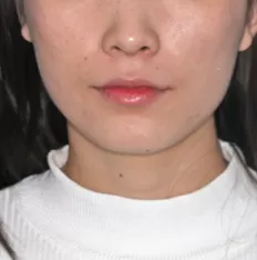 治療前の顔の写真
