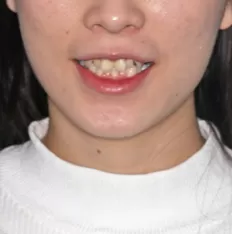 治療前の顔の写真
