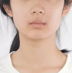 治療前の顔の写真