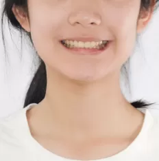治療前の顔の写真