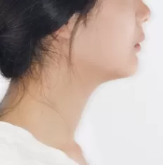 治療前の顔の写真
