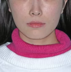 治療前の顔の写真
