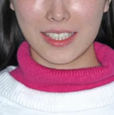 治療前の顔の写真