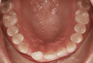 治療後の口腔内写真