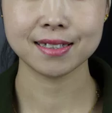 治療前の顔の写真
