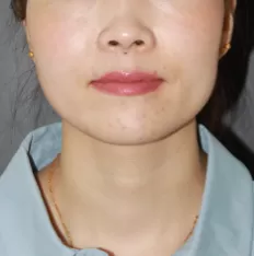 治療前の顔の写真