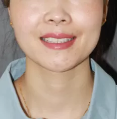 治療前の顔の写真