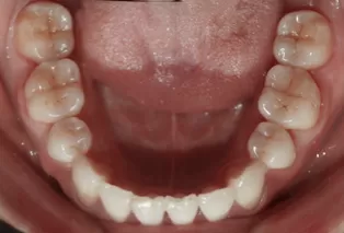 治療後の口腔内写真