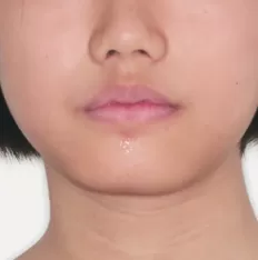 治療前の顔の写真