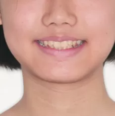 治療前の顔の写真