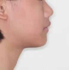 治療前の顔の写真