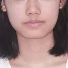 治療前の顔の写真