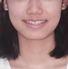 治療前の顔の写真