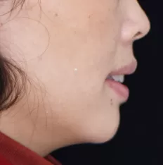 治療前の顔の写真