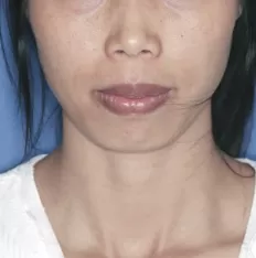 治療前の顔の写真