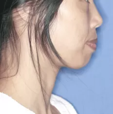 治療前の顔の写真