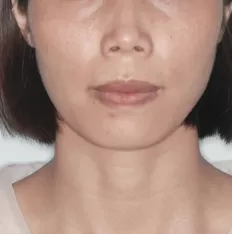 治療前の顔の写真