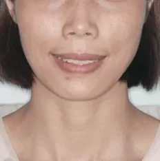 治療前の顔の写真