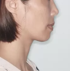 治療前の顔の写真