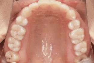治療後の口腔内写真